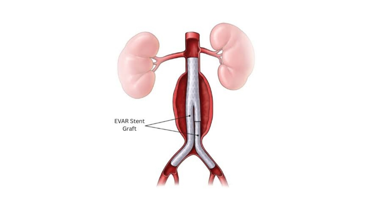 Aortic Aneurysm-PNN